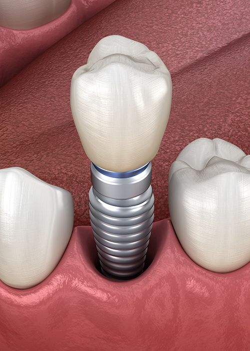 3D illustration of a dental implant in a jaw.